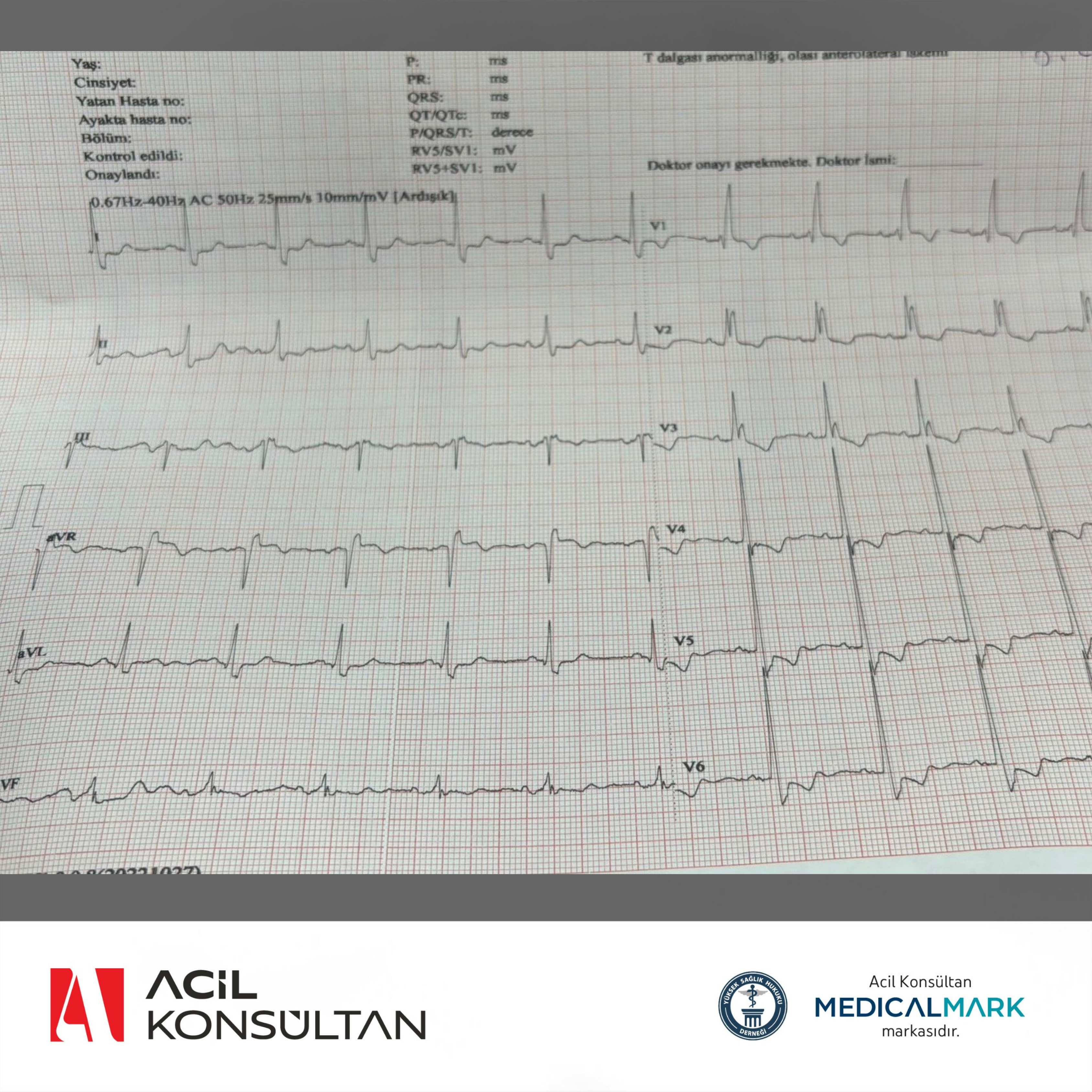 dinamik-ekg-degisikligi-aks-rbbb