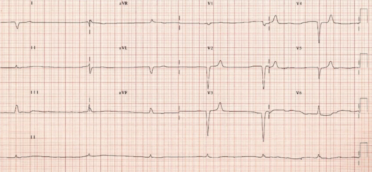 Hiperkalemi EKG Örneği 1