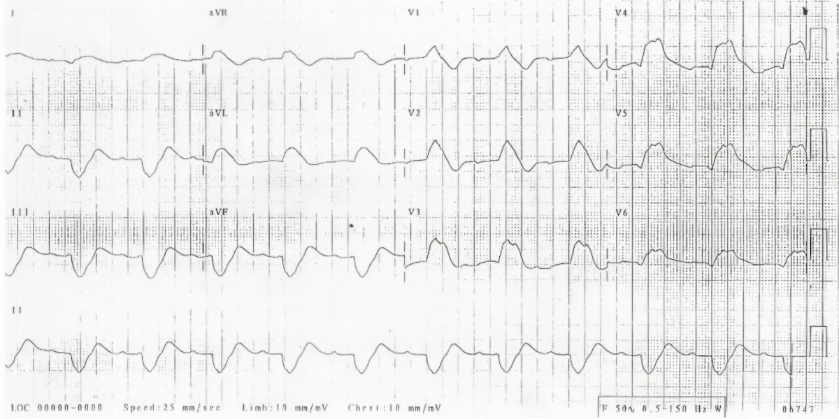 Hiperkalemi EKG Örneği 2