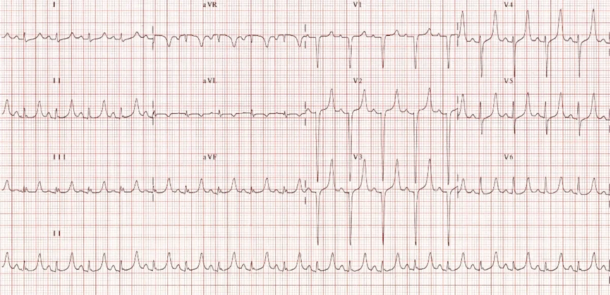 Hiperkalemi EKG Örneği 3