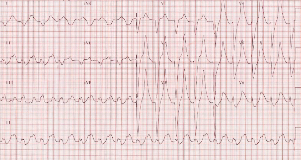 Hiperkalemi EKG Örneği 4