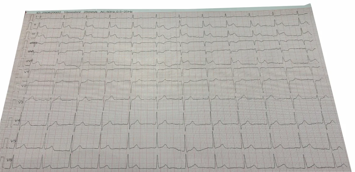 EKG Görüntüsü