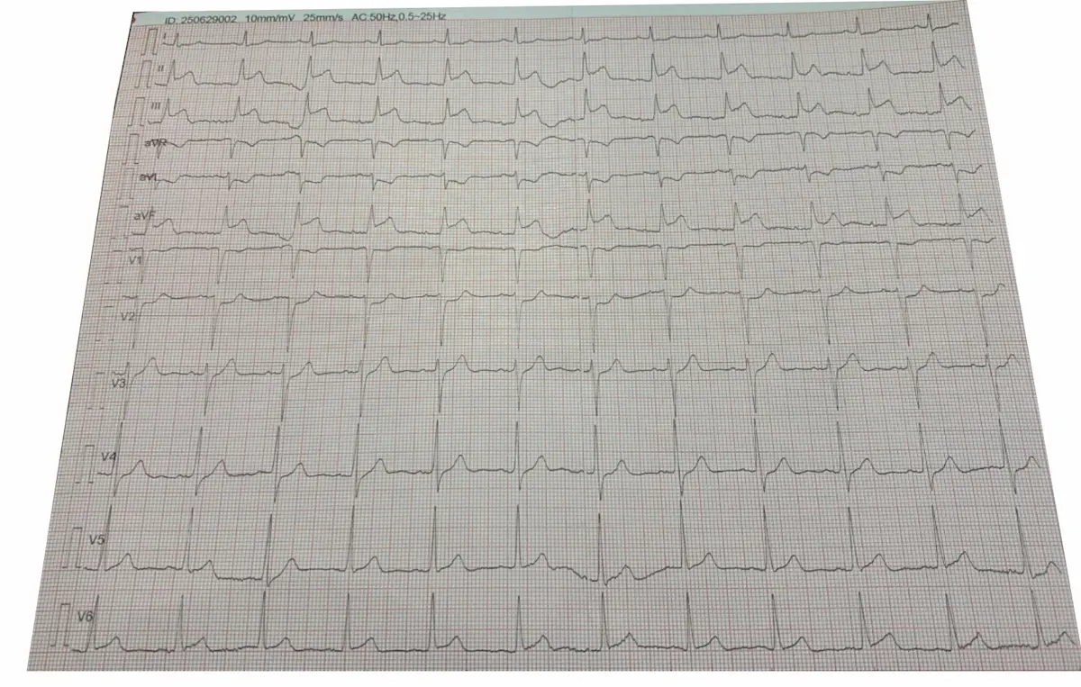EKG Görüntüsü