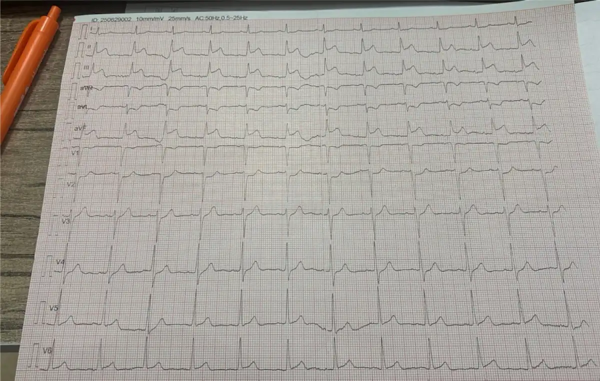 EKG Görüntüsü